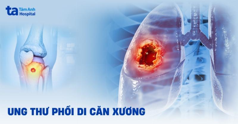 Ung Thư Di Căn Xương Giai Đoạn Cuối: Những Điều Cần Biết Để Đối Diện và Chăm Sóc